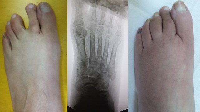 neuroma di morton chirurgia mininvasiva